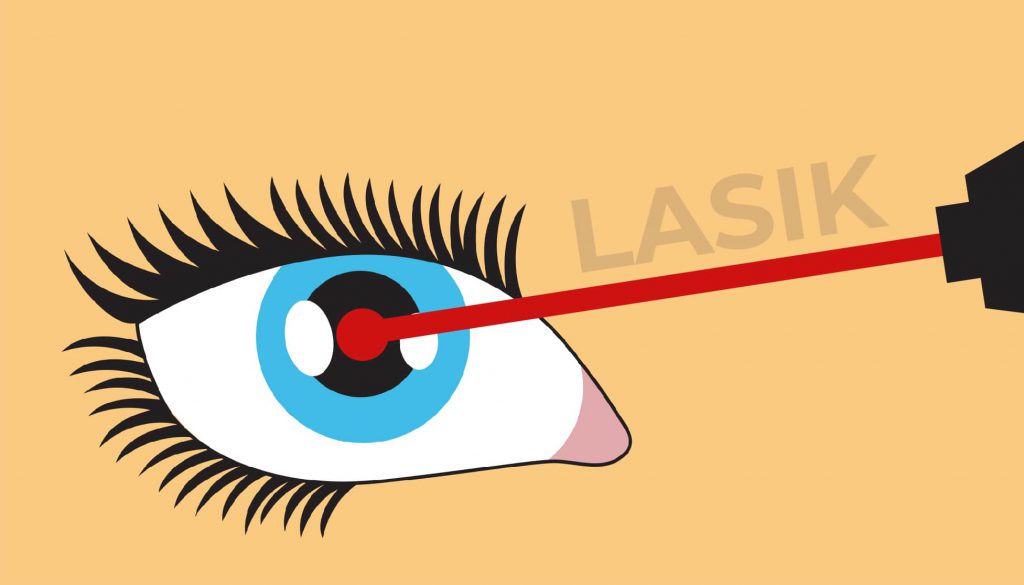 Laser lasik