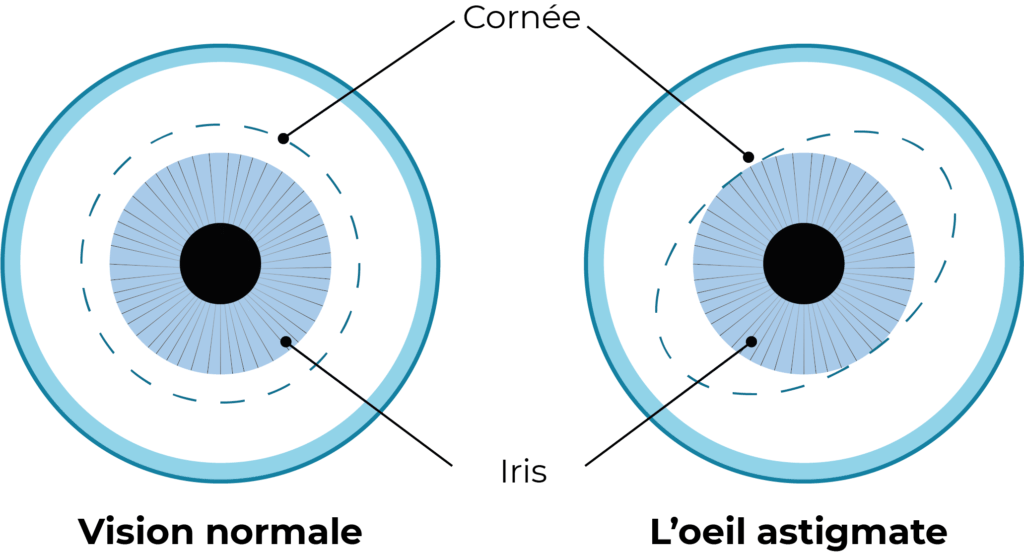difference entre un oeil normal et un oeil astigmate